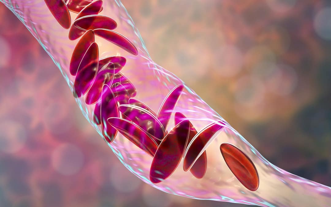 Disease-Modifying Therapies Remain Underused in Sickle Cell Disease Despite Safety and Efficacy