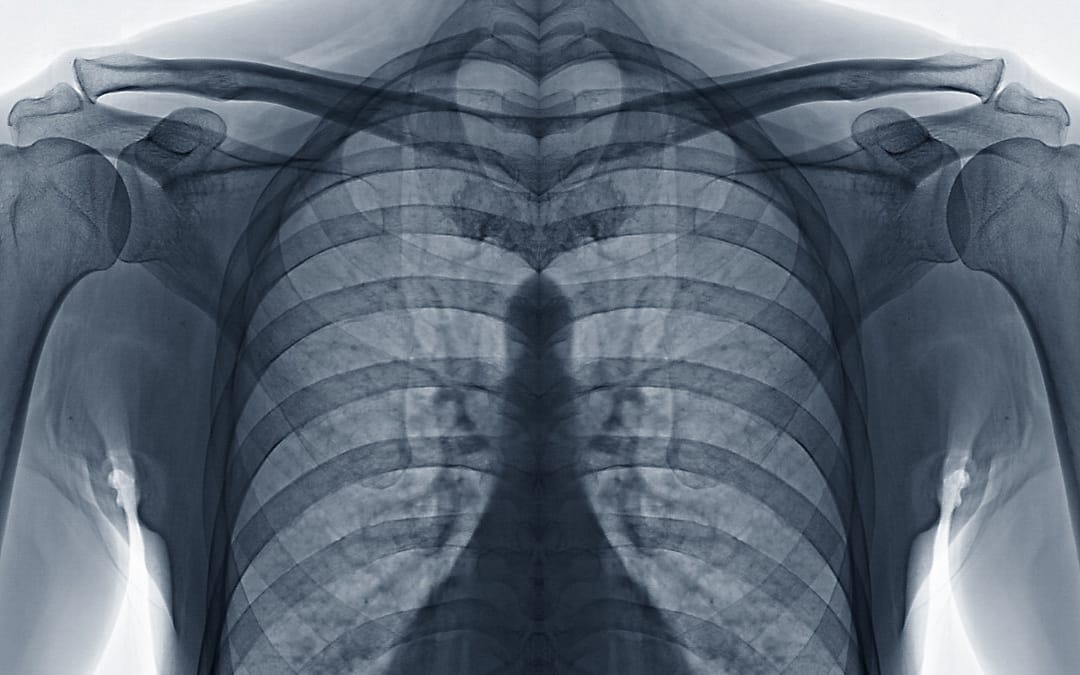 Funding Cuts Impact Access to TB Services Endangering Millions of Lives