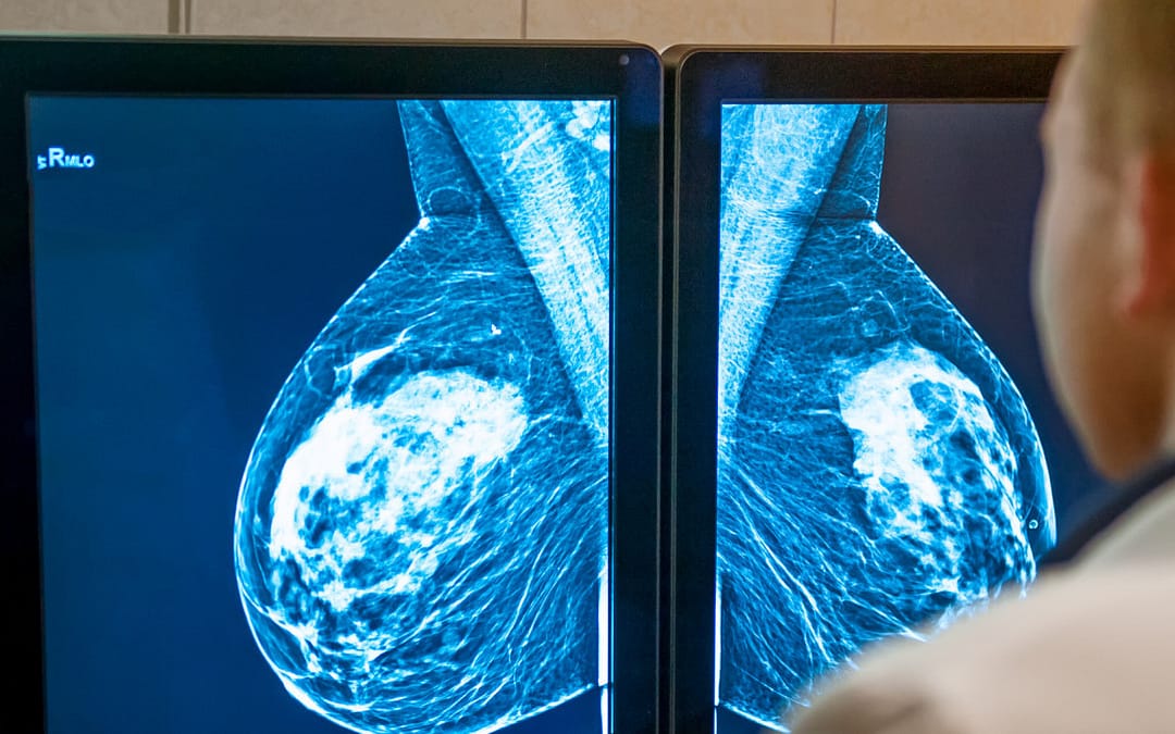 Breast and Colorectal Cancer Screening Rebound From Pandemic-Related Declines