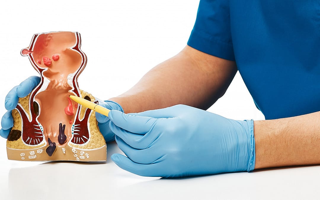 Rectal Cancer Mortality Is Rising Faster Than Colon Cancer