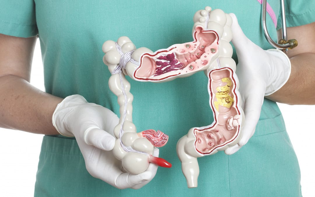 American Cancer Society Updates Colorectal Cancer Screening Guideline